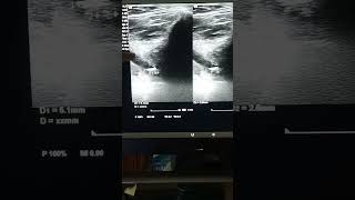 SIALOLITHIASIS WITH SIALADENITIS [upl. by Birmingham]