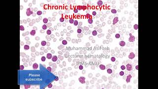 Chronic lymphocytic leukemia classification diagnosis and differential diagnosis in URDUHINDI [upl. by Zetnod]