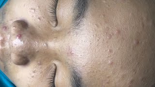 ACNE TREATMENT VU QUYNH MI  Blackheads Chin amp Nose Of Tweens 2024 EX [upl. by Lemmueu]