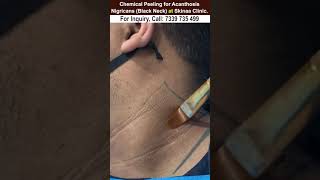 Chemical peeling for acanthosis nigricans black neck at skinaa clinic Viral shorts [upl. by Su651]