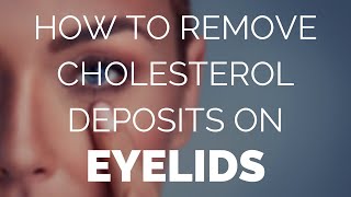 How to remove cholesterol deposits on eyelids Fast [upl. by Sexton]