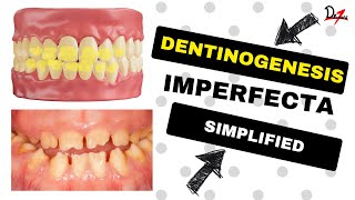 Dentinogenesis Imperfecta Simplified [upl. by Allenrad]