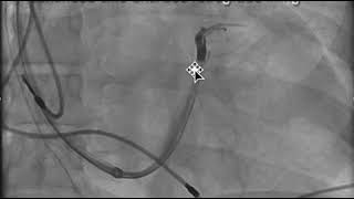 How to perform an occlusive CS venogram amp not miss proximal target veins 2018 kinshaw [upl. by Amitak]