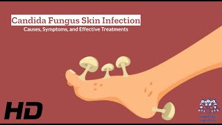 Candida Fungus Skin Infection Explained What You Need to Know [upl. by Tabber]