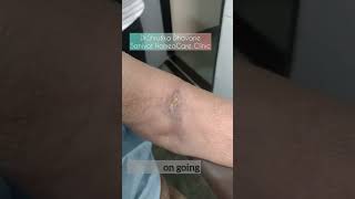 A case of Phlebitis Treated with Homeopathy  Case results drshrutikadhavane homeopathy [upl. by Tneciv]