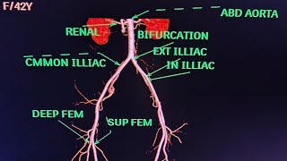 CT Lower Limb Angiography Anatomy CT scanPhilips avnishradiologyPart2 [upl. by Narot]