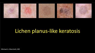 Lichen planus like keratosis  DrMMarchetti [upl. by Whit]