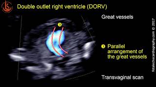 Fetal echocardiography at 1113 weeks Double Outlet Right Ventricle DORV [upl. by Kawasaki]