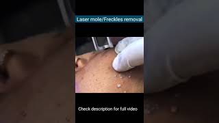 Laser mole Freckles removal [upl. by Shulem517]