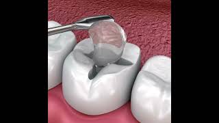 Teeth Inlays and Onlays  All Brite Dentistry inlay onlay dentist [upl. by Novej]