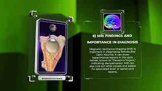 Retrobulbar Optic Neuritis [upl. by Osnofledi]