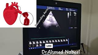 coarctation of Aorta 20 yrs old male missed and treated as a case of HTN 😱🙄 echocardiogram cardio [upl. by Hterrag]