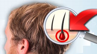 What Actually Causes Hair Loss [upl. by Airat]