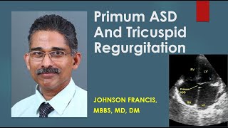 Primum ASD And Tricuspid Regurgitation [upl. by Ermeena571]