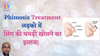 Treatment of Phimosis Cream for Phimosis Home remedy for Phimosis [upl. by Presley]