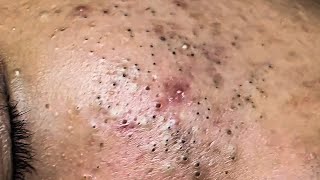 POPPING BLACKHEADS ON FACE NEWEST BLACKHEADS VIDEOS 2021 [upl. by Kayley394]