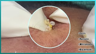 Big Cystic Acne Blackheads Extraction Blackheads amp Milia Whiteheads Removal Pimple Popping [upl. by Erlina]