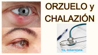 Orzuelo y Chalazión para el paciente [upl. by Brander861]