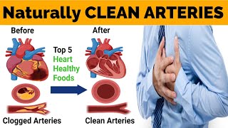 Foods to Unclogging Arteries Naturally and Prevent Heart Attack [upl. by Adelbert]