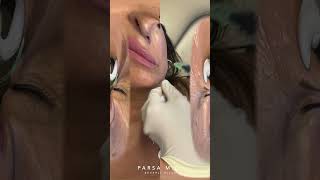 Botox Injection Sites for Crows Feet Bunny Lines amp Droopy Smile  Dr Kami Parsa [upl. by Nhguav808]