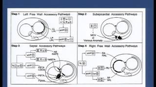 Pre  excitation syndromes  Dr Shashidhar 29092013 18 [upl. by Beall]