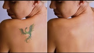 How to remove tattoo ink from skin at home  How to remove tattoo naturally [upl. by Engud]