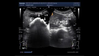 A Large vesical stone two cases [upl. by Long592]