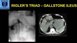 Riglers triad  Gallstone ileus II Understanding the concept [upl. by Aslin792]