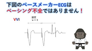 心電図：暗記からの卒業 第７０話 センシング不全 [upl. by Rosina]