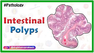 Intestinal polyps  Pathology lectures for fmge and neet pg [upl. by Nodnas]