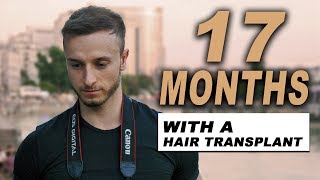 17 MONTHS AFTER HAIR TRANSPLANT [upl. by Ambrosia]