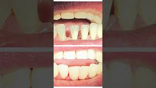 Diastema Closure  Dokter Gigi  Cuspaeni dentalcare veneers dentist trending fyp foryou jj [upl. by Pallua248]