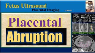 Fetus Ultrasound  Placental Abruption [upl. by Katha]