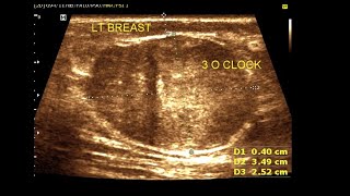 Fibroadenoma Breast  Breast imaging and clinical evaluation Sonographic technique [upl. by Rachaba612]