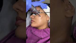 Carbon laser Skin lightening treatment Bhopal ✅Skin smile clinic carbon skismileckinic beauty [upl. by Jacquet]