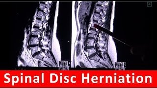 Spinal Disc Herniation in MRI scan by Radiology TV [upl. by Nonac]