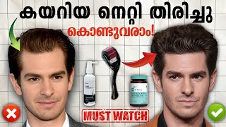 Receding hairline Re Grow your hair In 2 Methods Malayalam 🔱🔥 [upl. by Arthur]