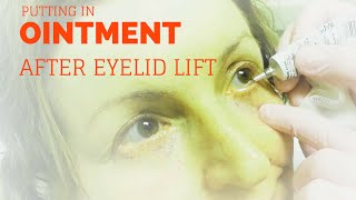 Putting ointment in your eyes after lower blepharoplasty [upl. by Perla49]