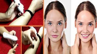 How to use Mole Removal Pen  Skin Tags and Mole removal Pen Demo [upl. by Camroc]