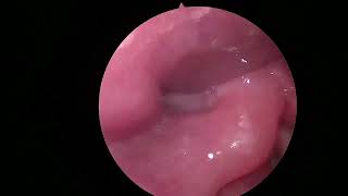 RIGHT VOCAL CORD PALSY  INTERMEDIATE POSITION  RIGHT RLN PALSY  larynx anatomy laryngoscope [upl. by Adnauq]