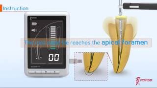 How to use Woodpecker Apex locator Woodpex III [upl. by Zelma]