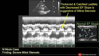 Mitral Stenosis on M Mode Echocardiogram  Echocardiography For Beginners [upl. by Vogele848]