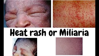 Heat rash Miliaria or Miliariapimples and rash due to heat or warmthDermatology lecture for MBBS [upl. by Harbour824]