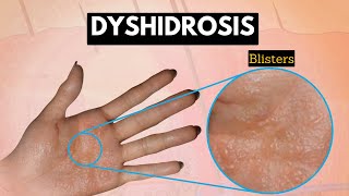 Dyshidrosis Causes Signs and Symptoms Diagnosis and Treatment [upl. by Attikin]