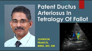 Patent Ductus Arteriosus In Tetralogy Of Fallot [upl. by Ltsyrk864]