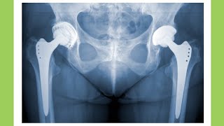 What is Hip Arthroplasty  shorts [upl. by Munafo]