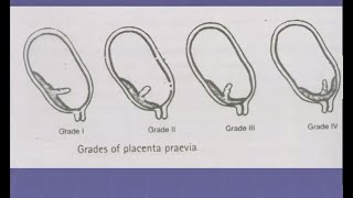 Antepartum Haemorrhage Lecture in Hindi  APH in Pregnancy  causes  Obstetrics and Gynecology OBS [upl. by Nolyarb]