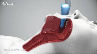 AirQ3®Intubating Laryngeal Airways InService Animation [upl. by Cottrell]