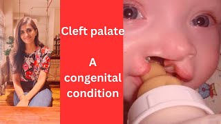 Cleft palate A congenital condition [upl. by Hsejar713]