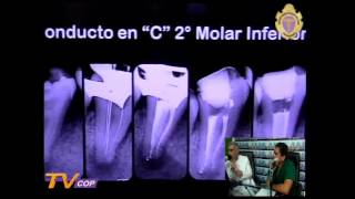 Debate Odontológico  Tratamiento de conductos curvos y atréficos [upl. by Waechter]